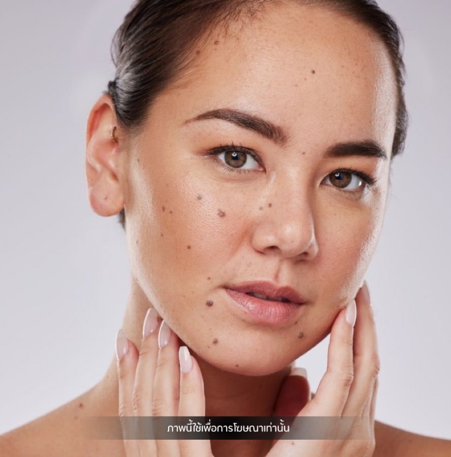 CO2 laser multiple-spot removal before and after result — client 4