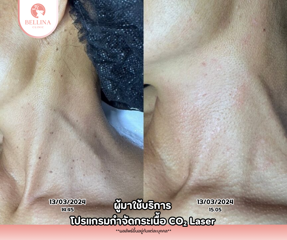 Real CO2 laser skin tag removal before and after — same visit, 20 minutes apart at Bellina Clinic