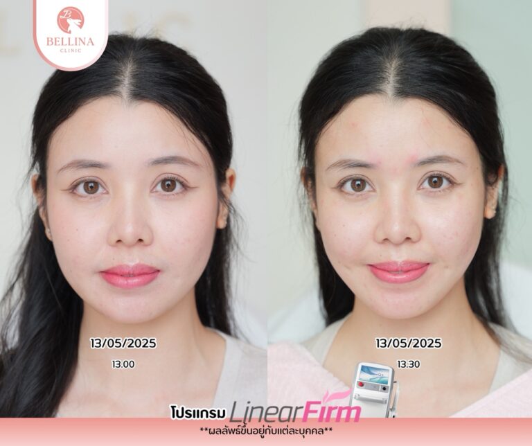 Before - After  - 13