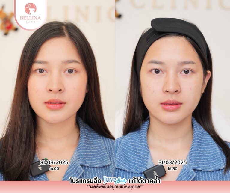 Before - After  - 16