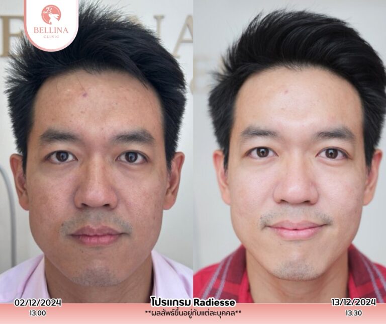 Before - After  - 19