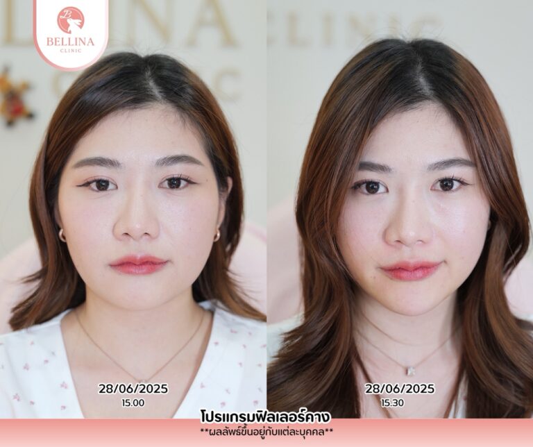 Before - After  - 24