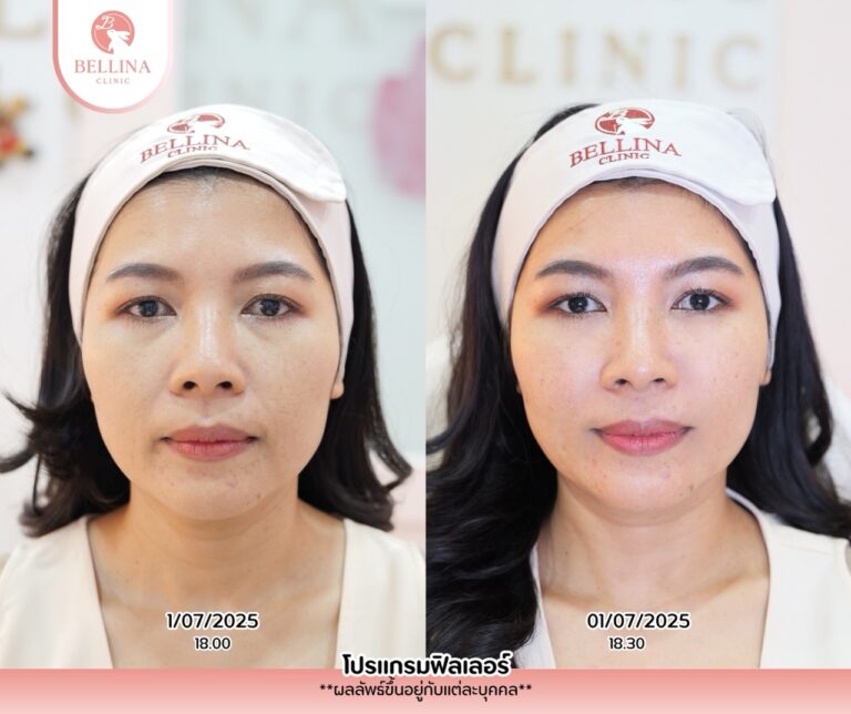 Before - After  - 27