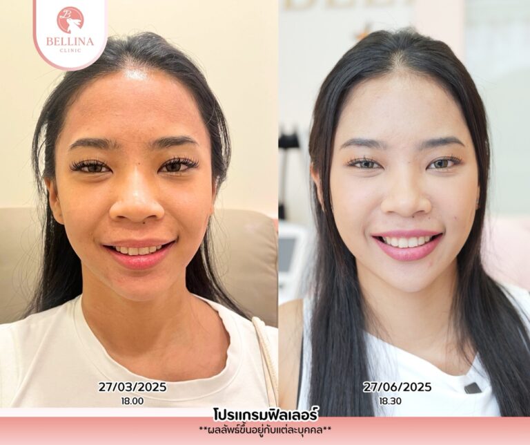 Before - After  - 30