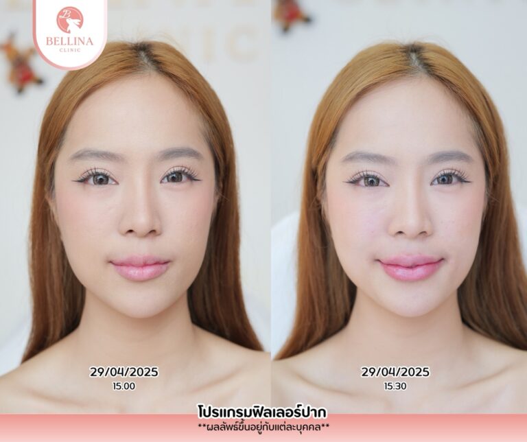 Before - After  - 7
