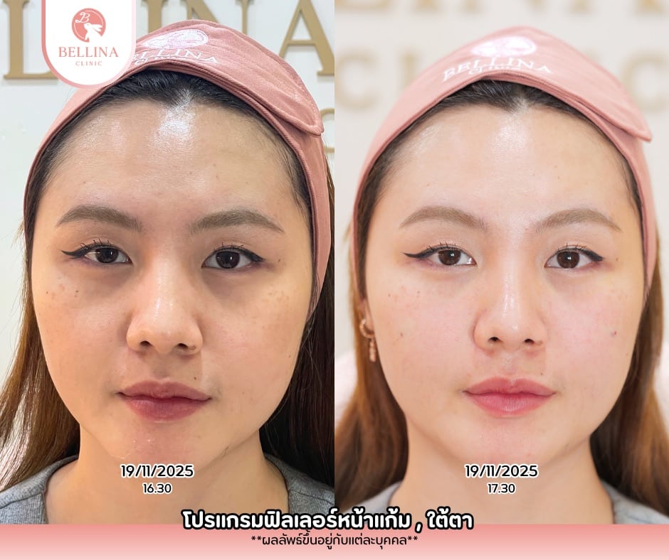 ฟิลเลอร์ใต้ตาคุณทิพย์