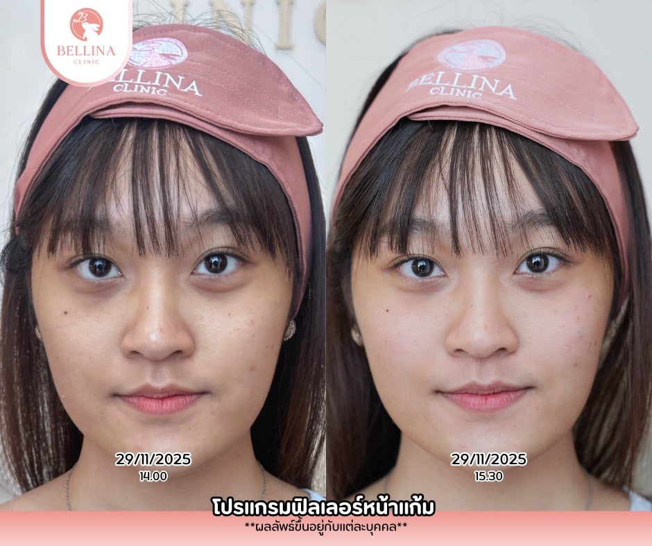 ฟิลเลอร์ใต้ตาคุณทิพย์
