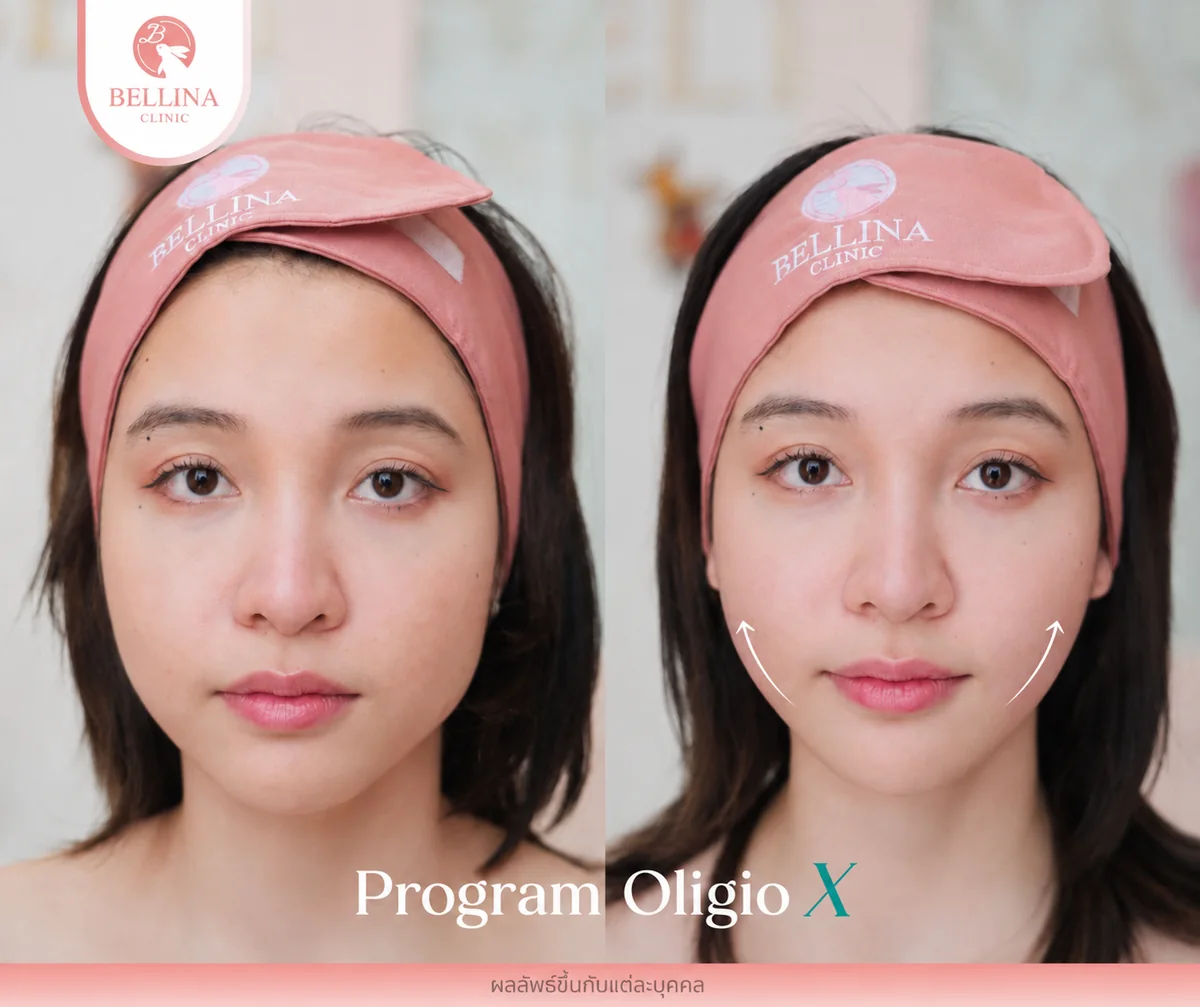 ก่อน-หลัง Oligio X รูปหน้าเรียวกระชับขึ้น Bellina Clinic