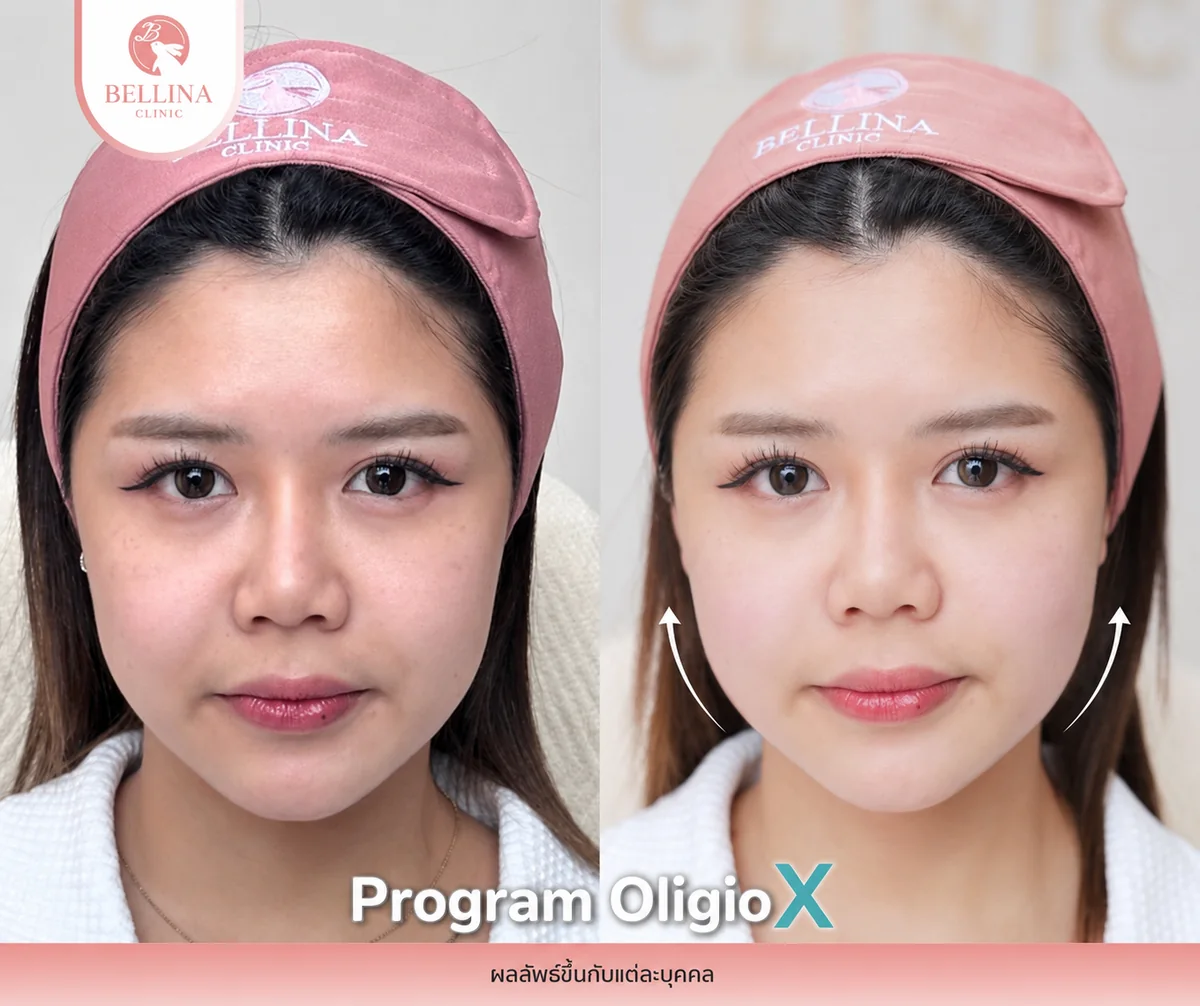 ก่อน-หลัง Oligio X กรอบหน้าชัดขึ้น Bellina Clinic